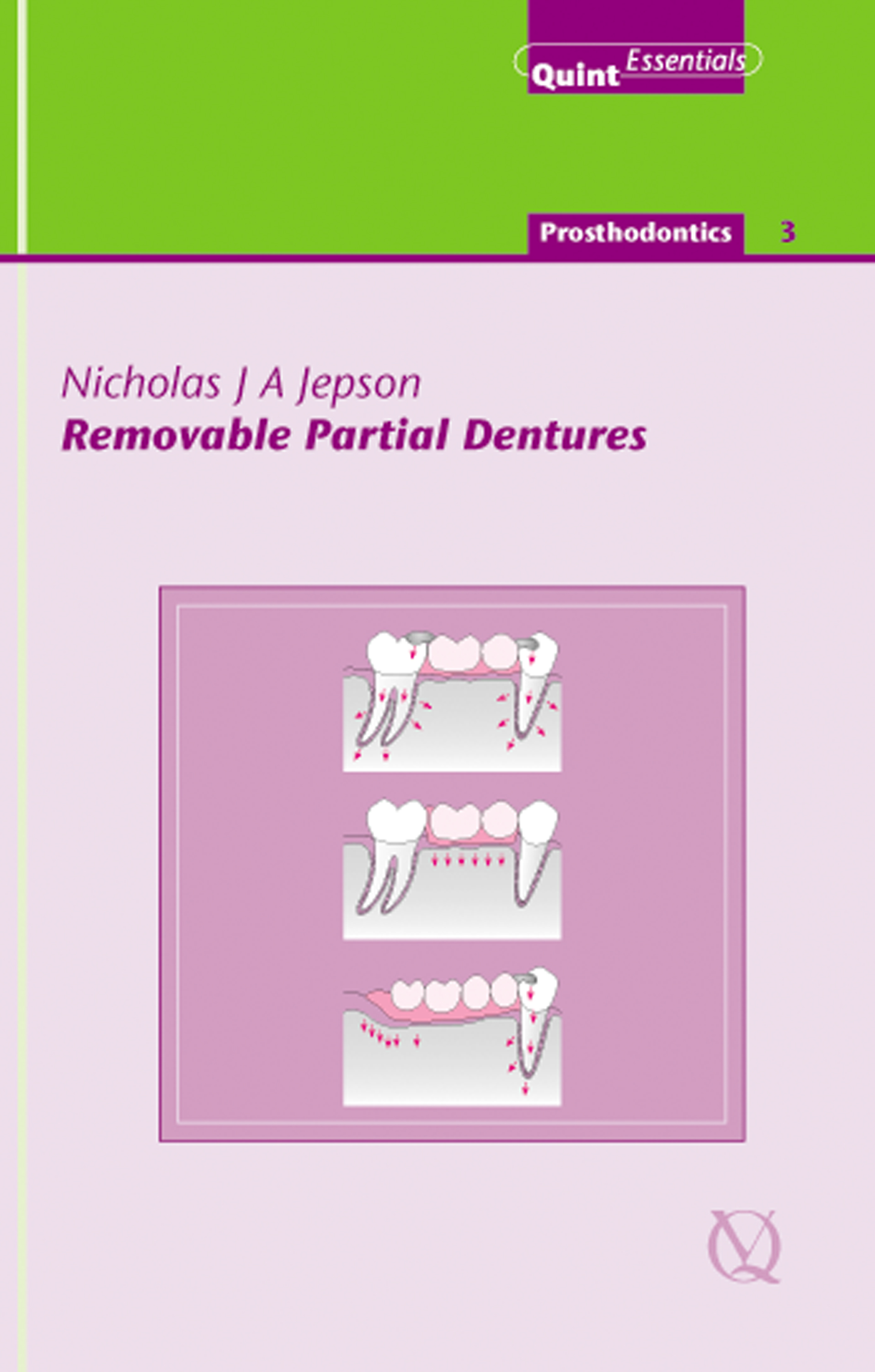 Removable Partial Dentures