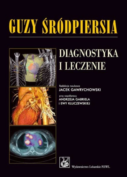 Группа авторов - Guzy śródpiersia. Diagnostyka i leczenie